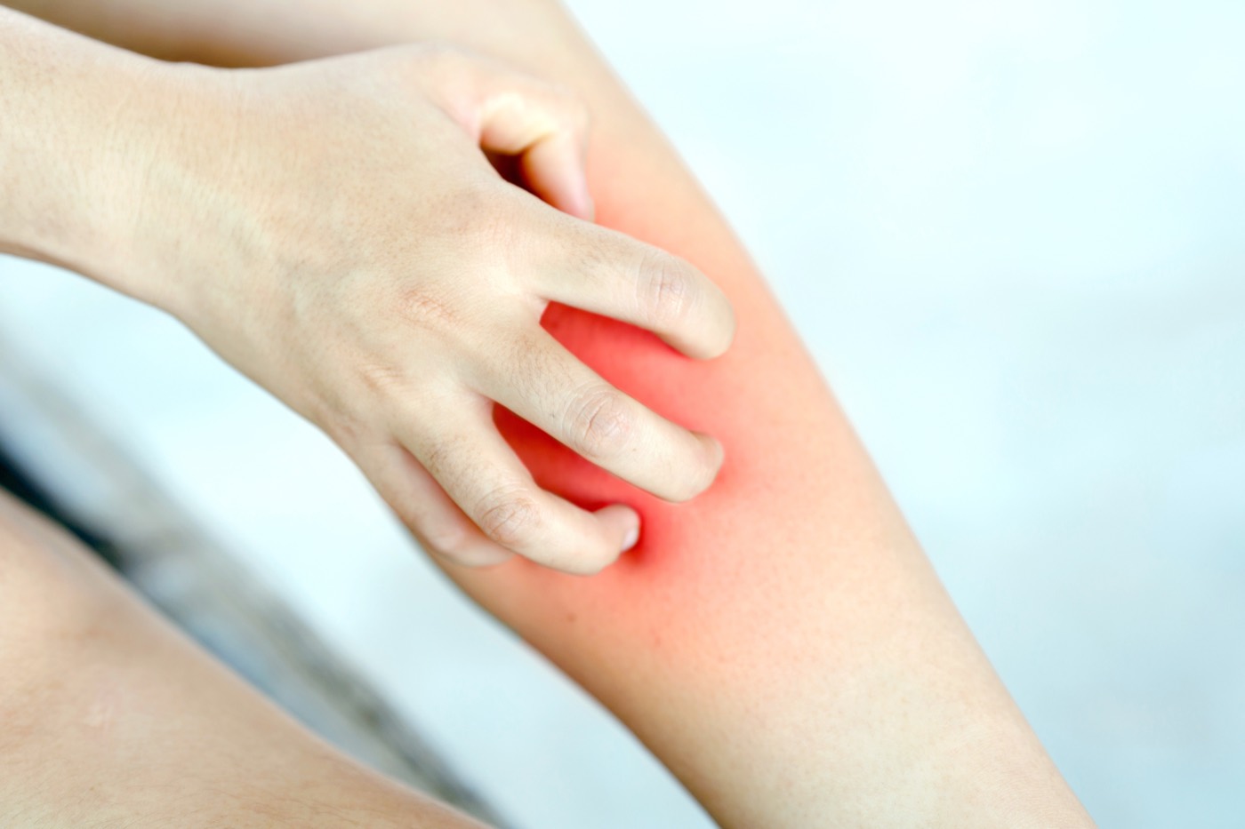 Patient with Prurigo Nodularis experiencing severe itching and skin irritation on the leg.