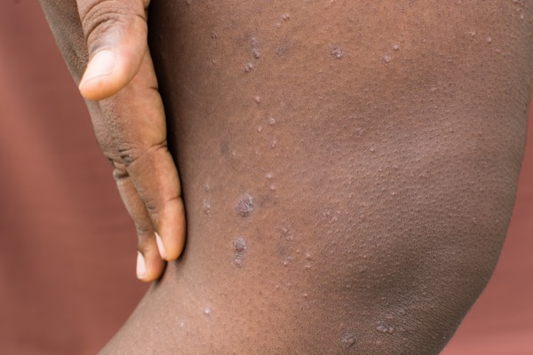 Woman suffering from Prurigo Nodularis with skin nodules on the leg.
